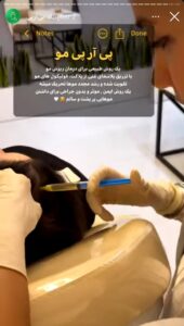 نمونه کار تزریق پی آر پی دکتر ابراهیمی در ساری