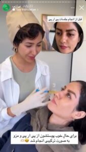 نمونه کار تزریق پی آر پی دکتر ابراهیمی در ساری