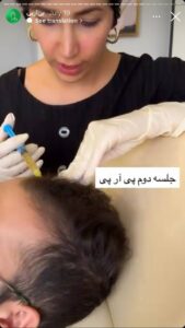 نمونه کار تزریق پی آر پی دکتر ابراهیمی در ساری