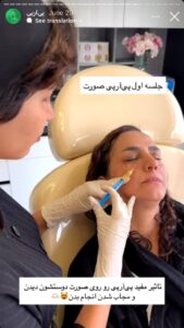 نمونه کار تزریق پی آر پی دکتر ابراهیمی در ساری