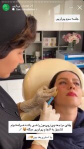 نمونه کار تزریق پی آر پی دکتر ابراهیمی در ساری