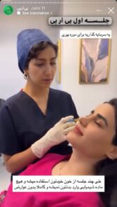 نمونه کار تزریق پی آر پی دکتر ابراهیمی در ساری