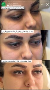 نمونه کار تزریق پی آر پی دکتر ابراهیمی در ساری