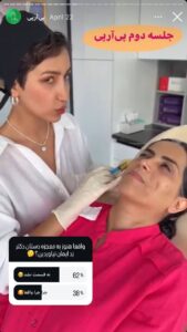 نمونه کار تزریق پی آر پی دکتر ابراهیمی در ساری