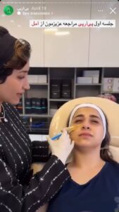 نمونه کار تزریق پی آر پی دکتر ابراهیمی در ساری