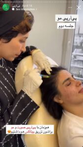 نمونه کار تزریق پی آر پی دکتر ابراهیمی در ساری