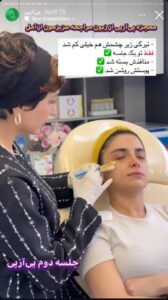 نمونه کار تزریق پی آر پی دکتر ابراهیمی در ساری