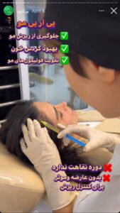 نمونه کار تزریق پی آر پی دکتر ابراهیمی در ساری