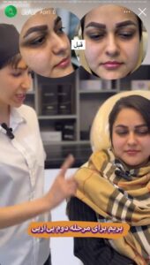 نمونه کار تزریق پی آر پی دکتر ابراهیمی در ساری