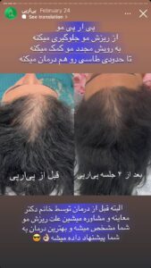 نمونه کار تزریق پی آر پی دکتر ابراهیمی در ساری