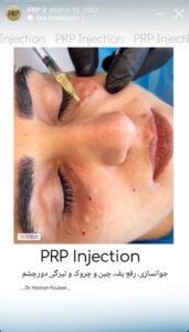 نمونه کار تزریق پی آر پی دکتر اسلامی در ساری