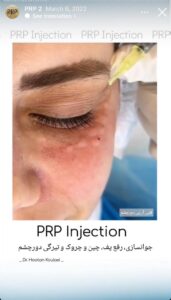 نمونه کار تزریق پی آر پی دکتر اسلامی در ساری