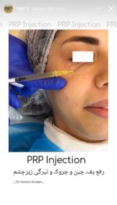 نمونه کار تزریق پی آر پی دکتر اسلامی در ساری