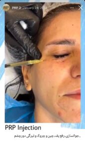 نمونه کار تزریق پی آر پی دکتر اسلامی در ساری