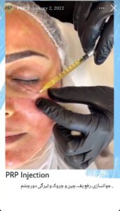 نمونه کار تزریق پی آر پی دکتر اسلامی در ساری