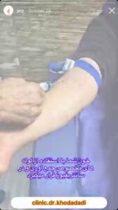 نمونه کار تزریق پی آر پی دکتر خدادادی در ساری