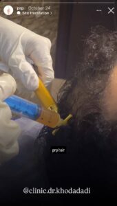 نمونه کار تزریق پی آر پی دکتر خدادادی در ساری