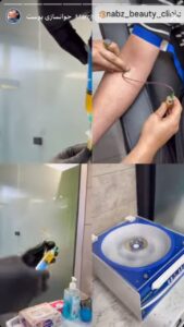 نمونه کار تزریق پی آر پی کلینیک نبض در ساری