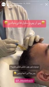 نمونه کار تزریق پی آر پی دکتر حبیبی در ساری