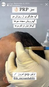 نمونه کار تزریق پی آر پی دکتر حبیبی در ساری