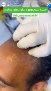 نمونه کار تزریق پی آر پی دکتر حبیبی در ساری