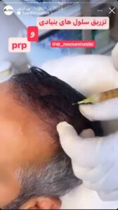 نمونه کار تزریق پی آر پی دکتر حبیبی در ساری