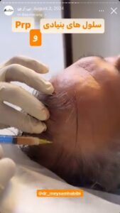نمونه کار تزریق پی آر پی دکتر حبیبی در ساری