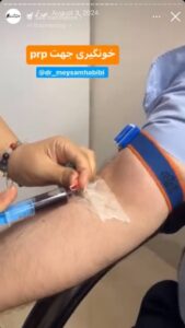 نمونه کار تزریق پی آر پی دکتر حبیبی در ساری