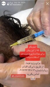 نمونه کار تزریق پی آر پی دکتر حبیبی در ساری