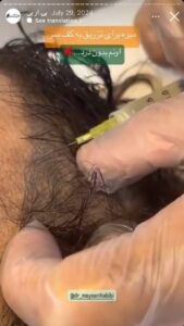 نمونه کار تزریق پی آر پی دکتر حبیبی در ساری