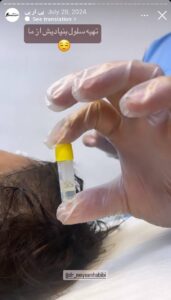 نمونه کار تزریق پی آر پی دکتر حبیبی در ساری