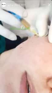 نمونه کار تزریق پی آر پی دکتر حبیبی در ساری