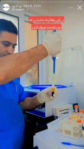 نمونه کار تزریق پی آر پی دکتر حبیبی در ساری