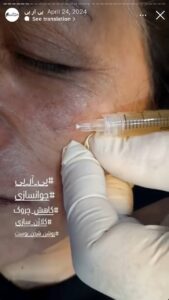 نمونه کار تزریق پی آر پی دکتر حبیبی در ساری