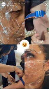 نمونه کار تزریق پی آر پی دکتر حبیبی در ساری