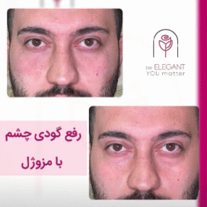 نمونه تزریق مزوژل کلینیک زیبایی الگانت