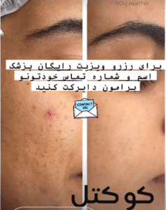 نمونه تزریق مزوژل کلینیک زیبایی الگانت