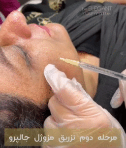 نمونه تزریق مزوژل کلینیک زیبایی الگانت