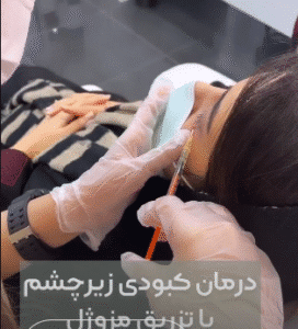 نمونه تزریق مزوژل کلینیک زیبایی الگانت