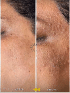 نمونه تزریق مزوژل کلینیک زیبایی الگانت