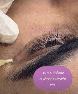 نمونه تزریق مزوژل کلینیک زیبایی الگانت