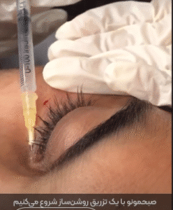 نمونه تزریق مزوژل کلینیک زیبایی الگانت