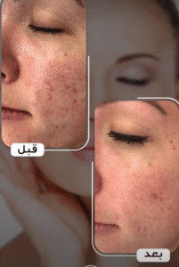 نمونه تزریق مزوژل کلینیک زیبایی الگانت