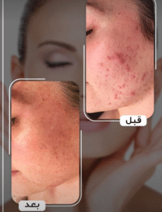 نمونه تزریق مزوژل کلینیک زیبایی الگانت