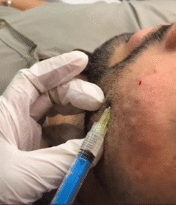 نمونه تزریق مزوژل کلینیک زیبایی الگانت