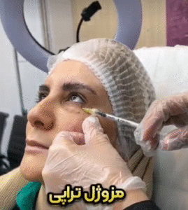 نمونه تزریق مزوژل کلینیک زیبایی الگانت