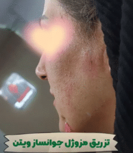 نمونه تزریق مزوژل کلینیک زیبایی الگانت