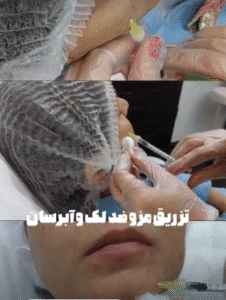 نمونه تزریق مزوژل کلینیک زیبایی الگانت