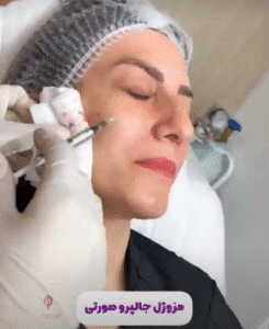 نمونه تزریق مزوژل کلینیک زیبایی الگانت