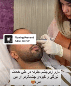 نمونه تزریق مزوژل کلینیک زیبایی الگانت